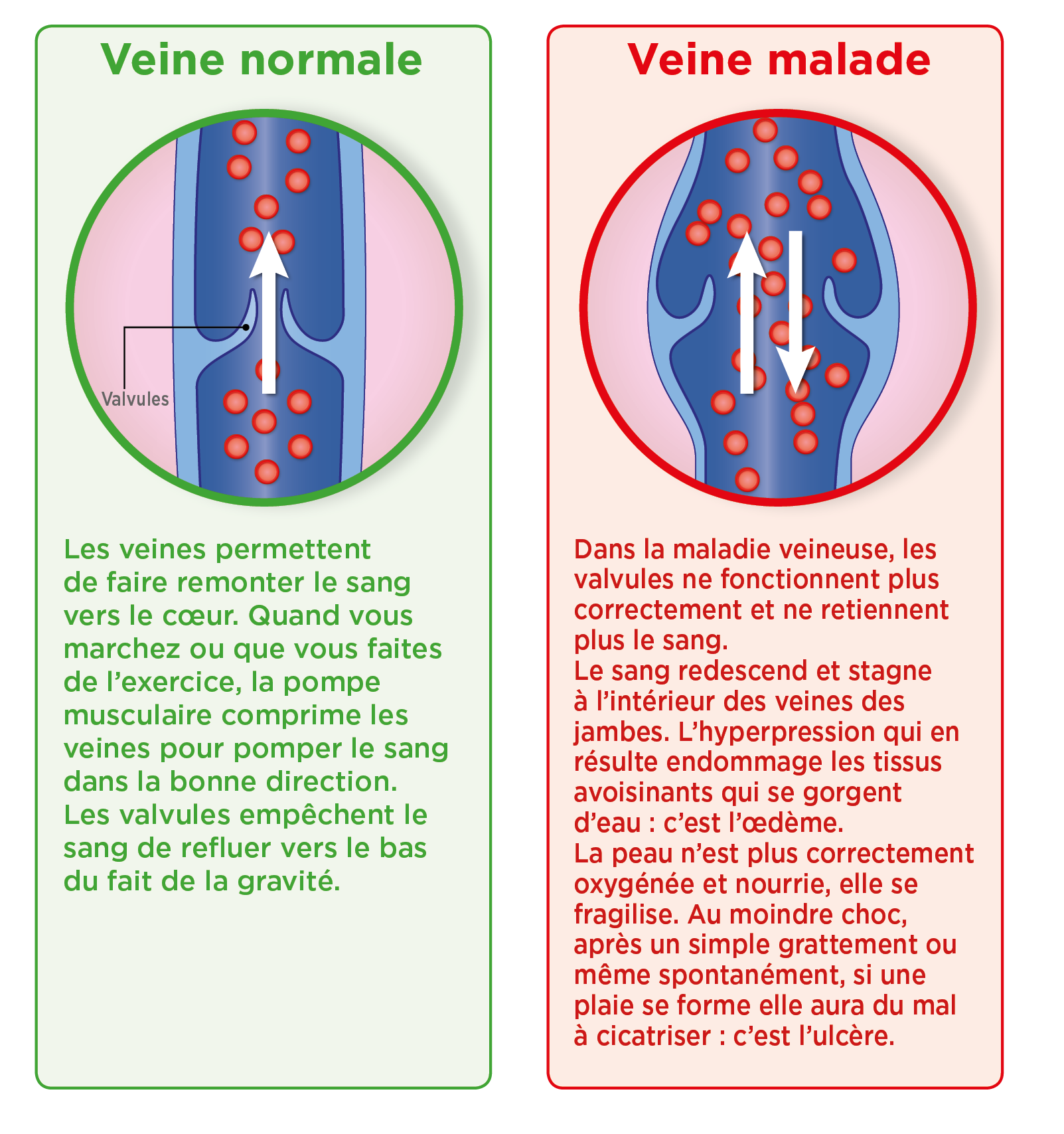 schéma veine malade